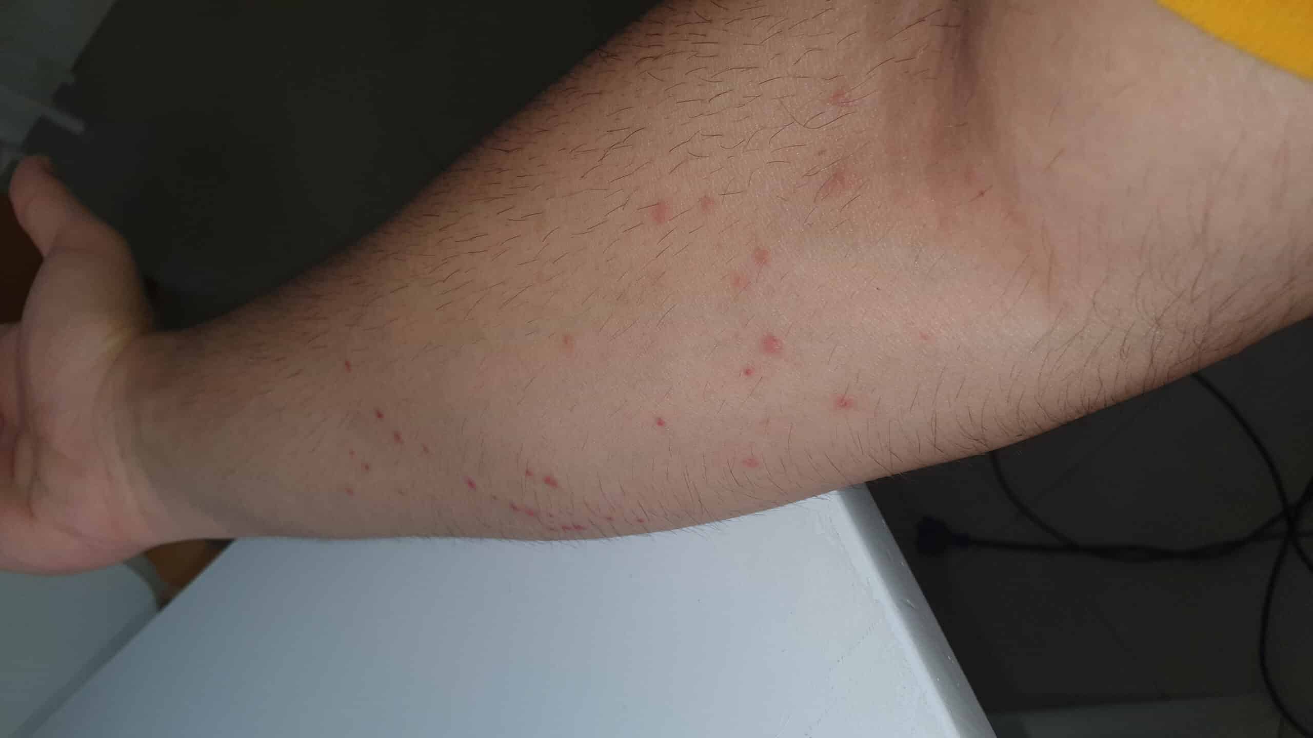 Bed Bite Marks
