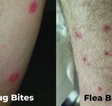 Bed Bug Bites Vs Flea Bites