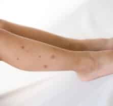bed bug allergies