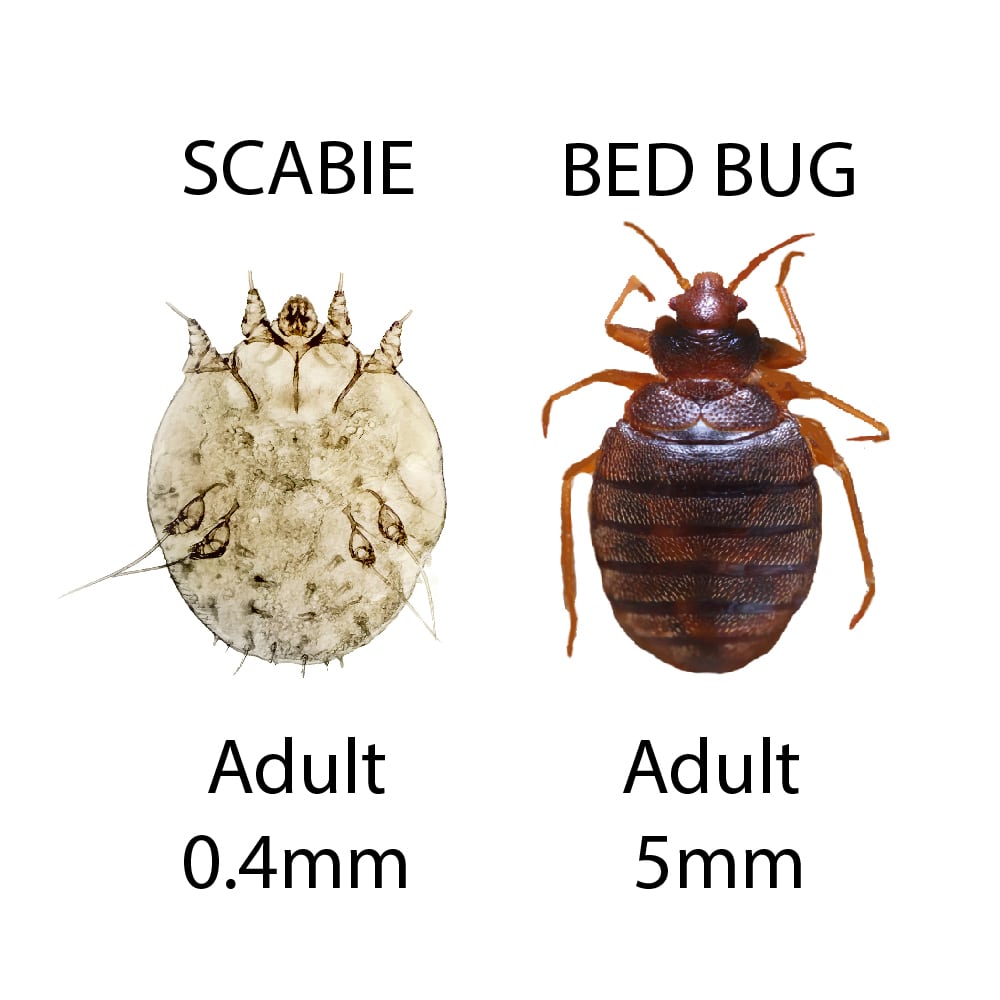 Scabies vs Bed Bugs