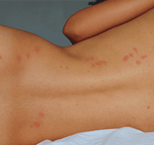 bed bug rash treatment
