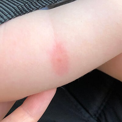 bed bug bite on baby