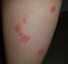 chigger bites vs bed bug bites