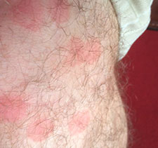 bug bed bites bite rash questions collated often customers come ve