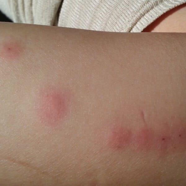 bed bug bites