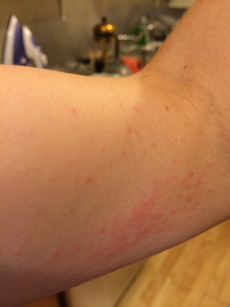 bed bug rash