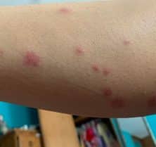 How Long Does It Take for Bed Bug Bites to Appear?