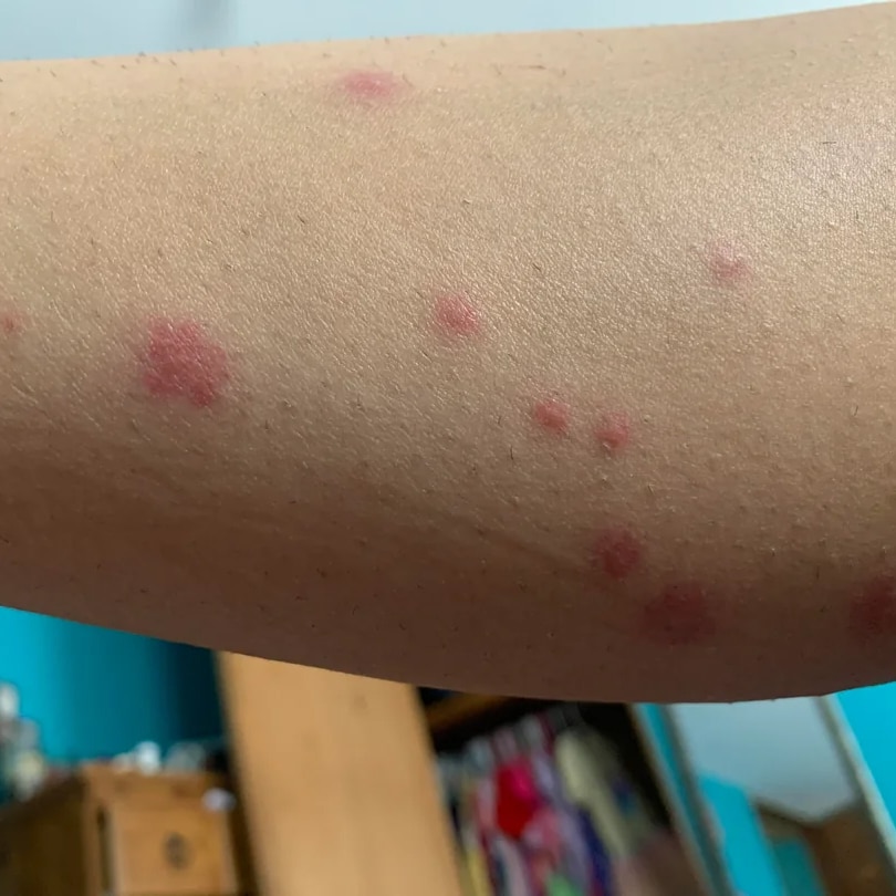 How Long Does It Take for Bed Bug Bites to Appear?