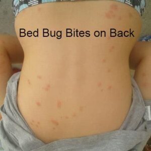 bed bug vs flea bites