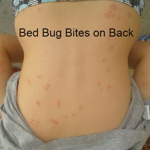 Bed Bug Bites on Back