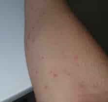 Bed Bug Bites in Australia