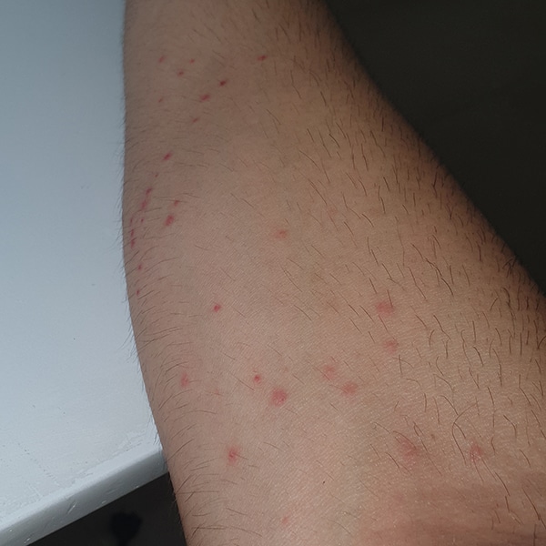 Bed Bug Bites in Australia