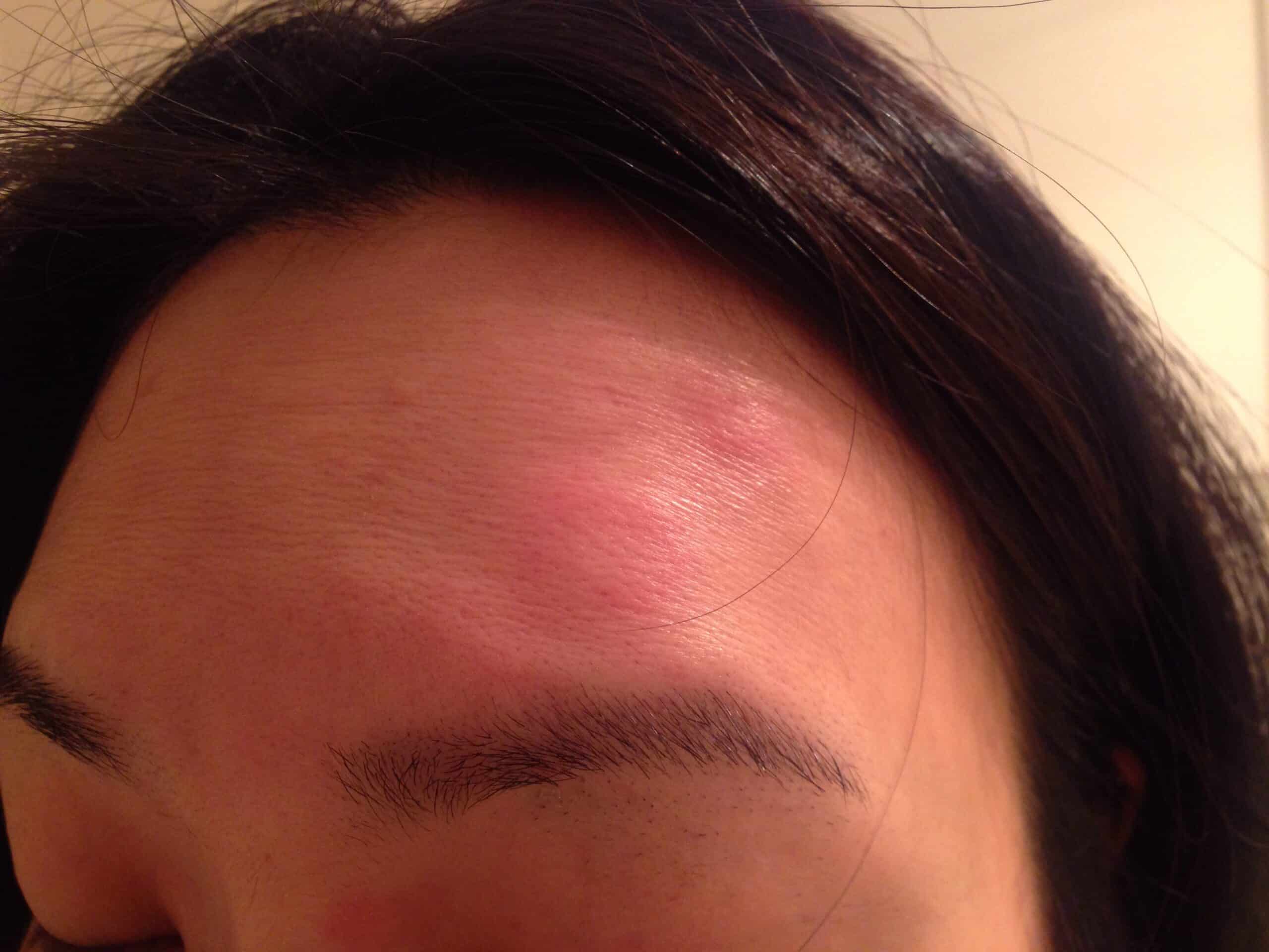 bed bug bite on forehead