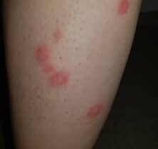 bed bug bites on leg