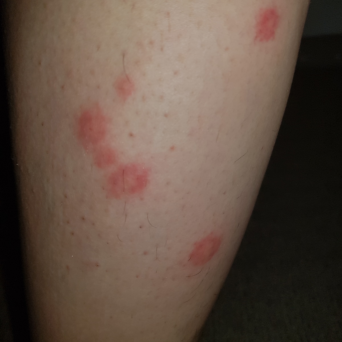 bed bug bites on leg