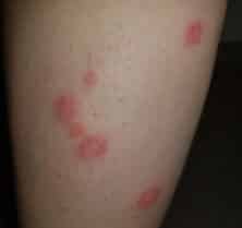 bed bug bites on leg large