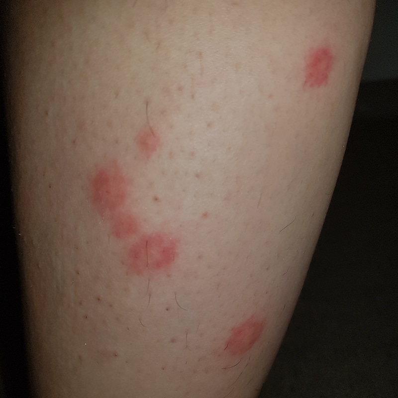 bed bug bites on leg large