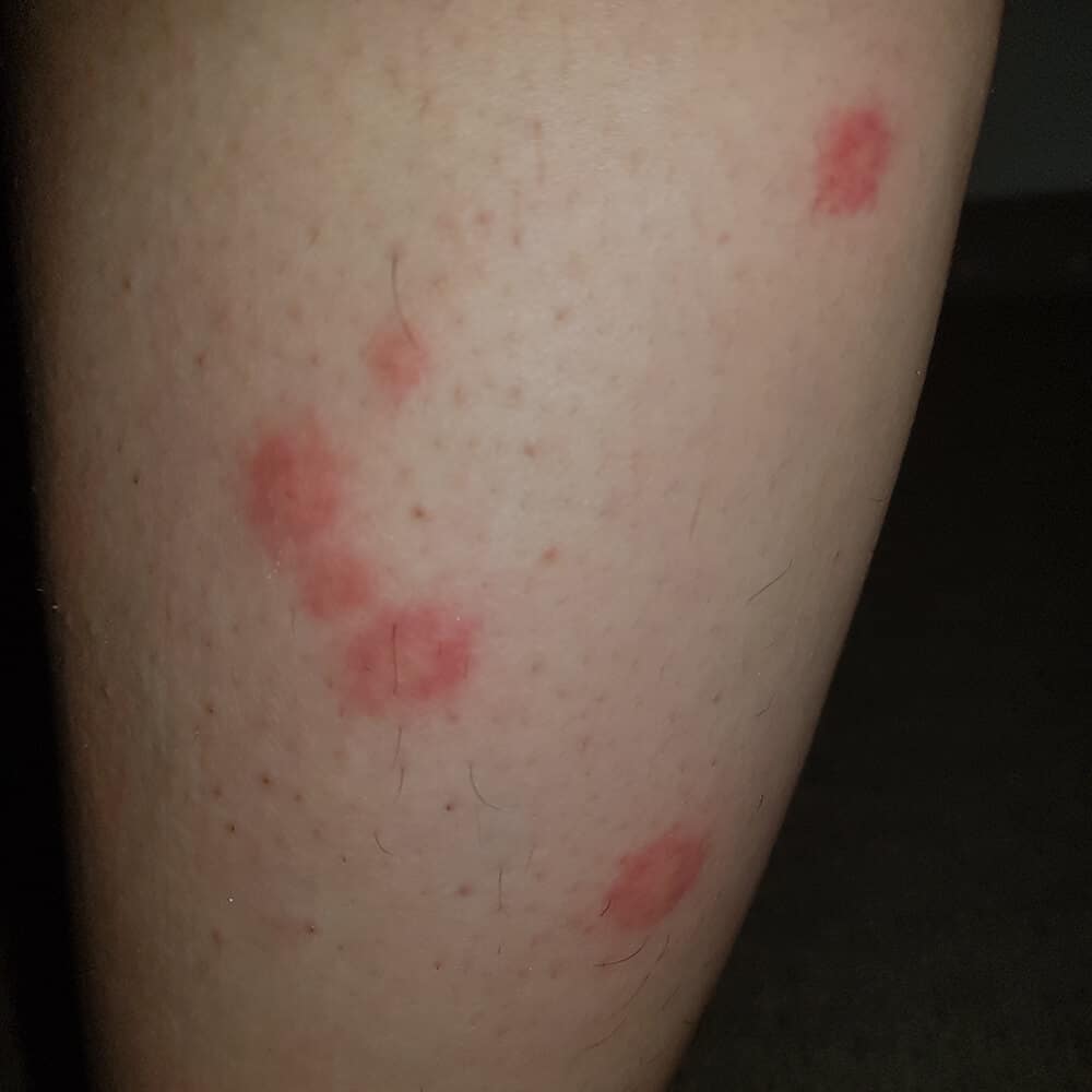 bed bug bites on leg