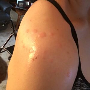 bedbug bites