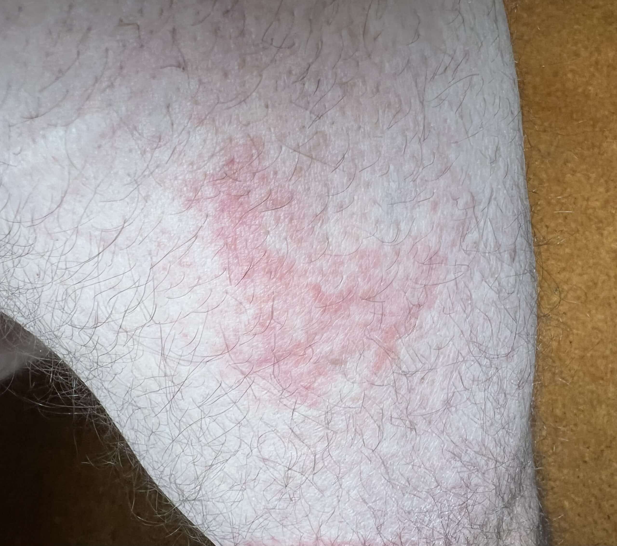 bed bug allergies