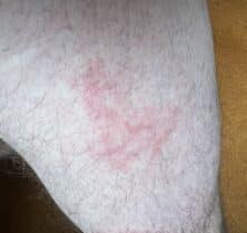bed bug rash upper leg