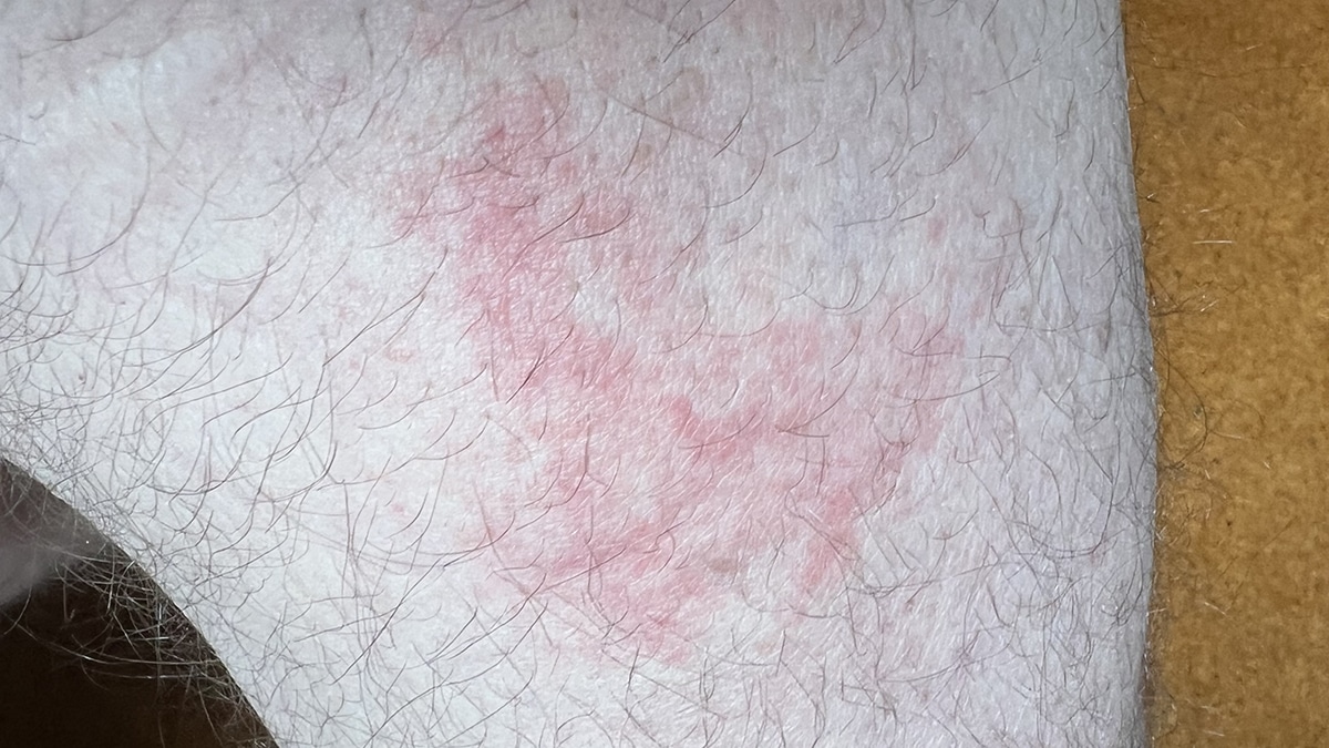 bed bug rash upper leg