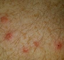 bed bug symptoms