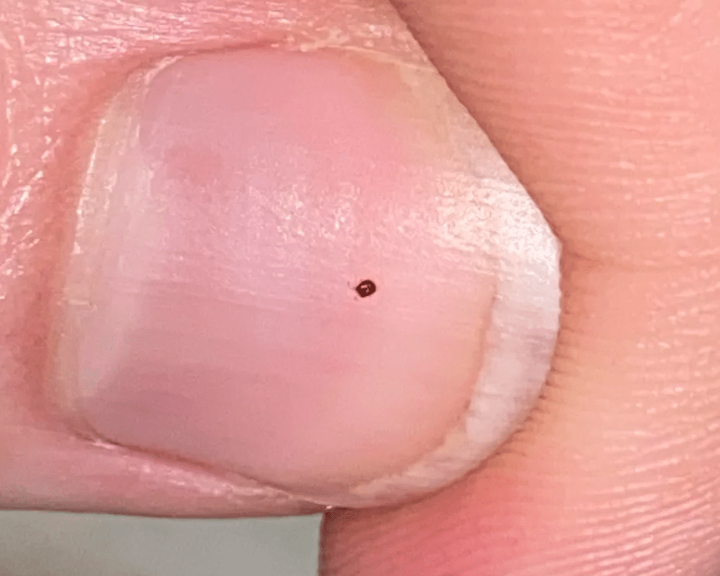 bird mite on fingernail
