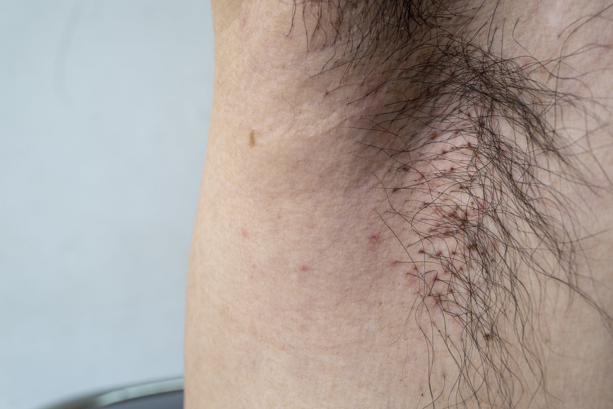Crabs In Armpit