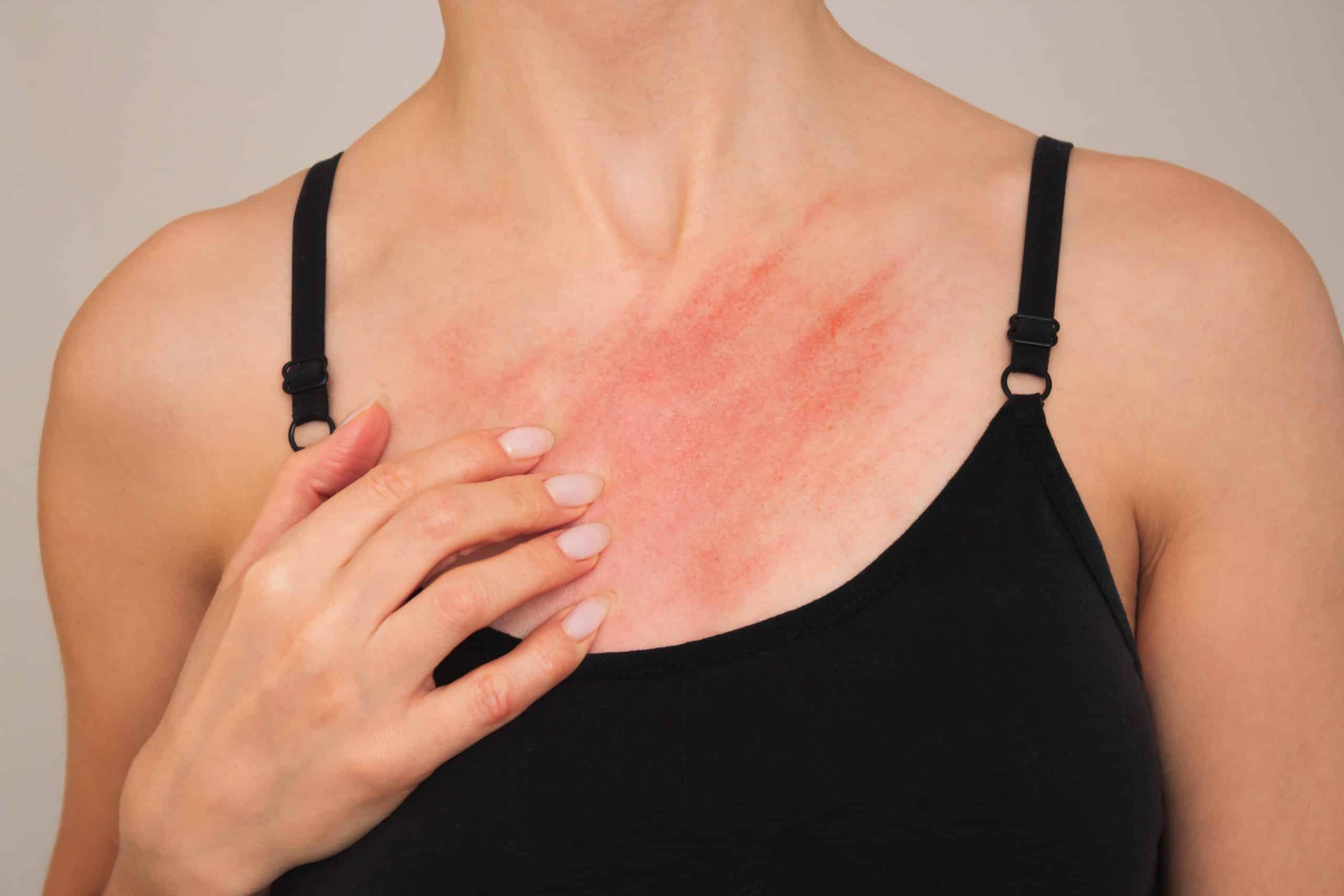 Scabies Rash