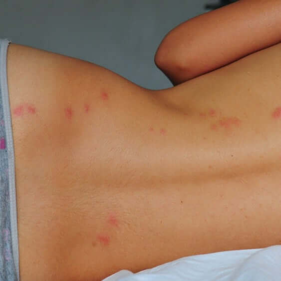 Picture of bed bug bites rash