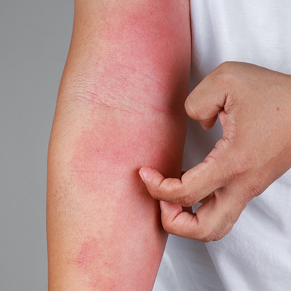 itchy skin from dust mite allergy