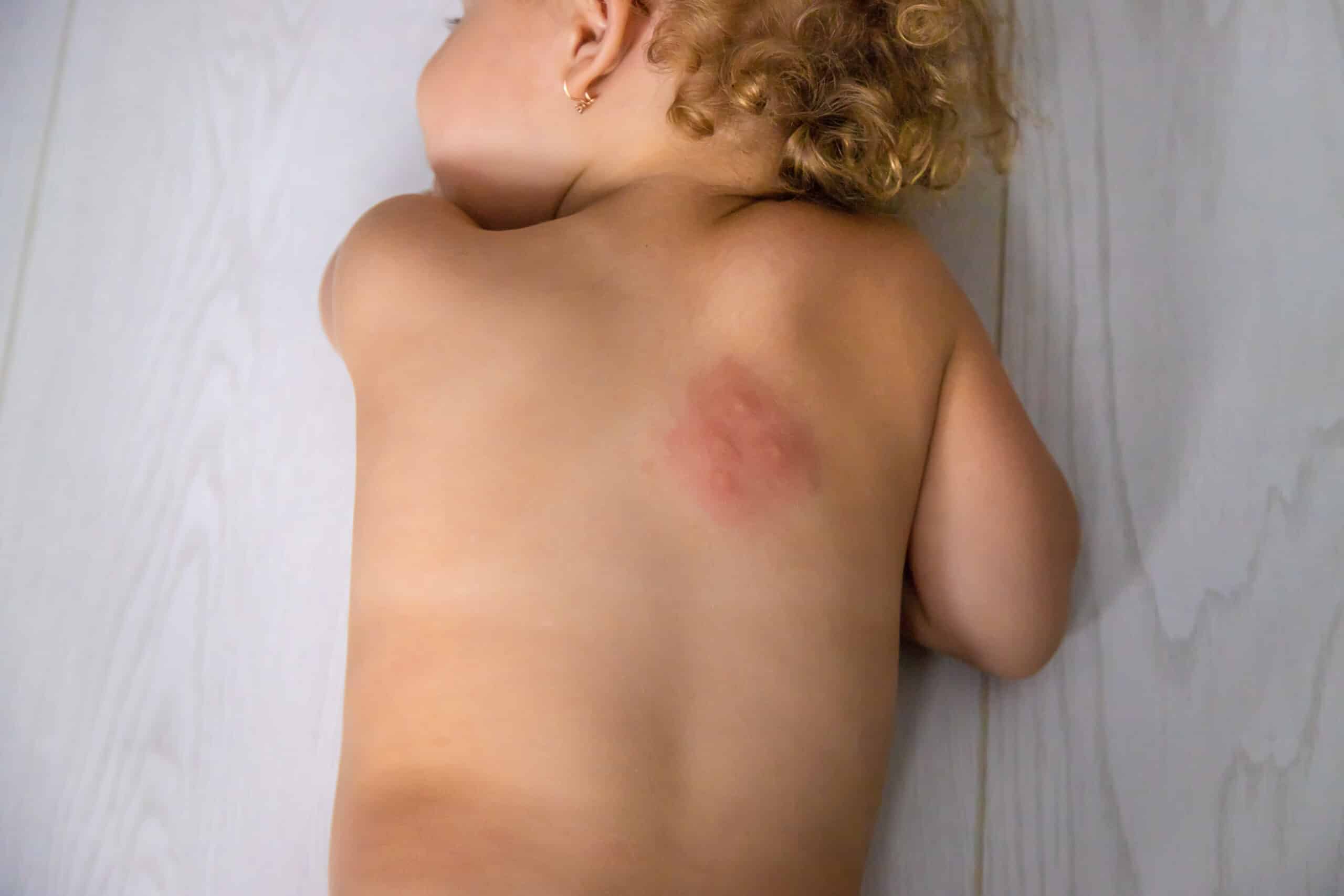 bed bug bite on a child